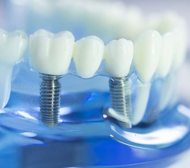 Beaverton Dental Implants