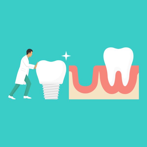 The Process Of Getting Dental Implants
